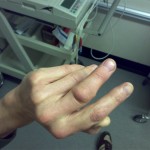A dislocated finger
